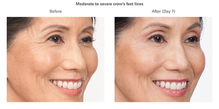 luminary-cosmetic-injectables-before-after-100x500_1