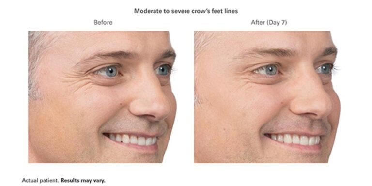 luminary-cosmetic-injectables-before-after-100x500_2