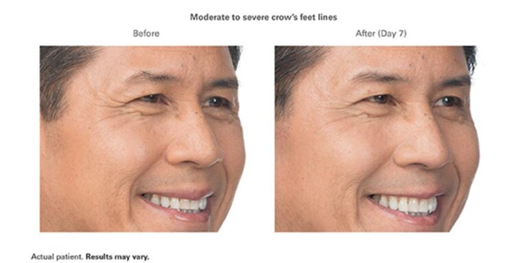 luminary-cosmetic-injectables-before-after-100x500_3