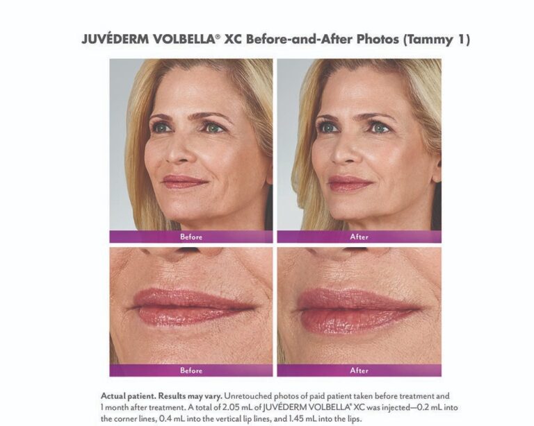 luminary-cosmetic-injectables-before-after-100x800_1