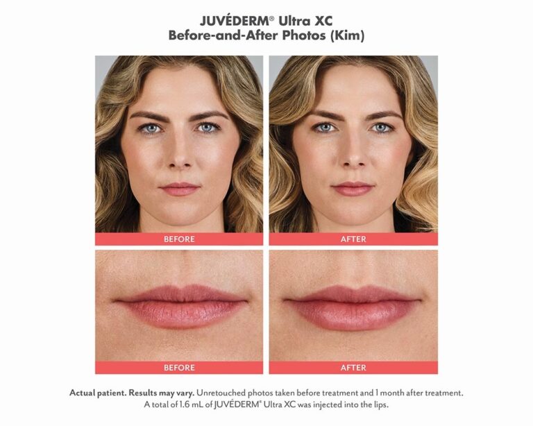 luminary-cosmetic-injectables-before-after-100x800_3