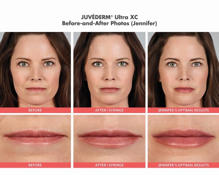 luminary-cosmetic-injectables-before-after-100x800_5