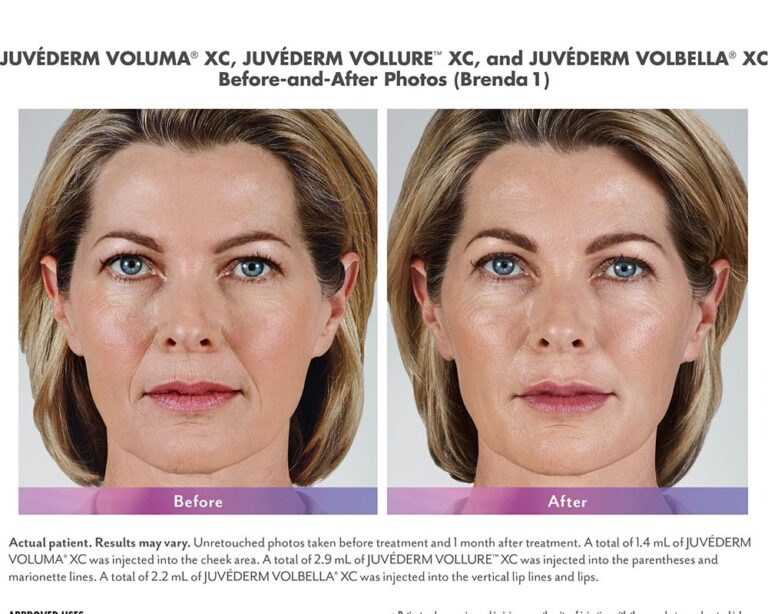 luminary-cosmetic-injectables-before-after-100x800_6