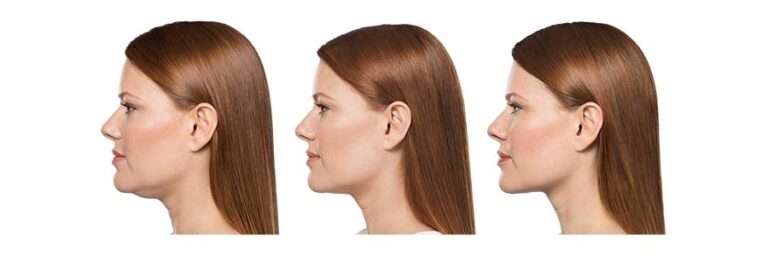 luminary-kybella-before-after-1