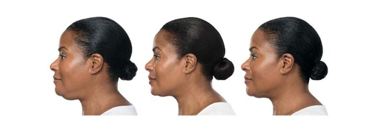 luminary-kybella-before-after-2