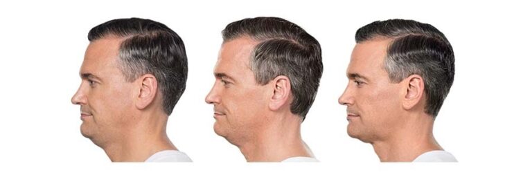 luminary-kybella-before-after-3