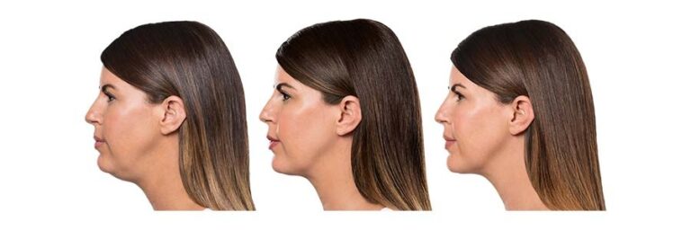 luminary-kybella-before-after-4
