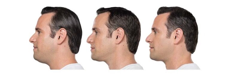 luminary-kybella-before-after-5