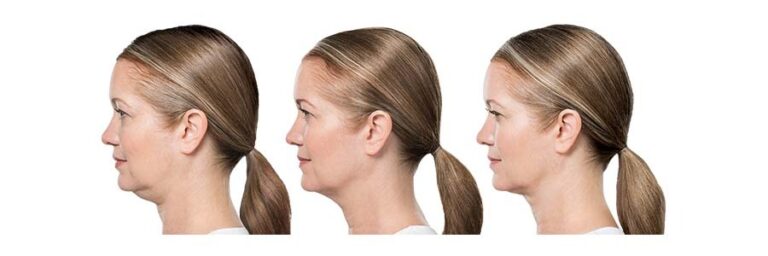 luminary-kybella-before-after-6